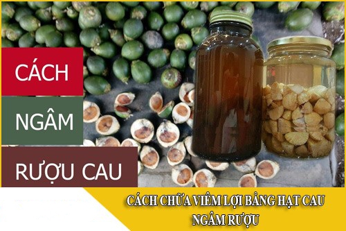 Hướng Dẫn Ngâm Rượu Hạt Cau Chữa Đau Răng Tại Nhà
